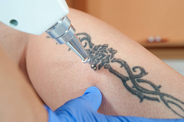 Laser Tattoo Removal